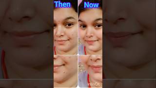 My acne journey with plix serum#shortsviral#youtubeshorts#beauty#skincare