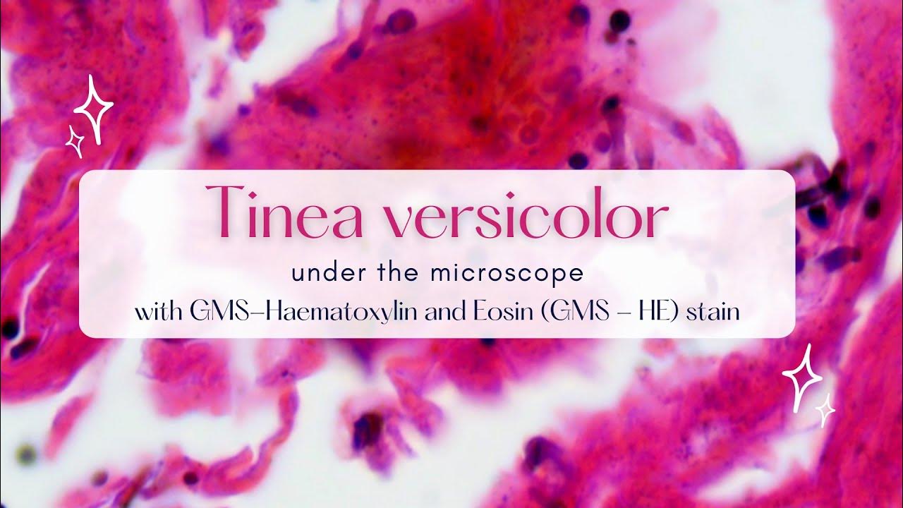 Tinea versicolor under the microscope with GMSHaematoxylin and Eosin