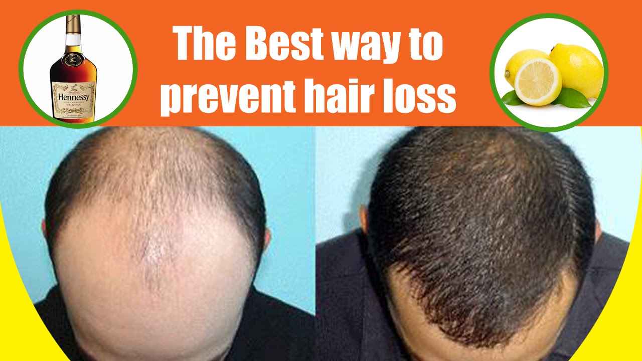 best way to stop hair loss