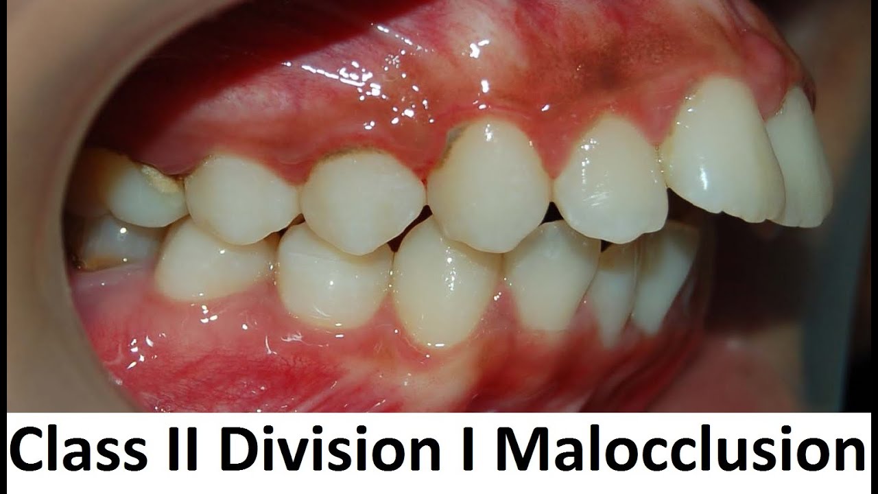 Can Class II Division I of Malocclusion Be Treated With Orthotropics by  Prof John Mew 