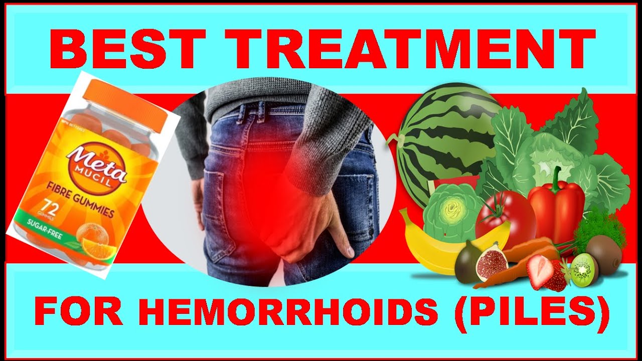 Best Treatment for hemorrhoids (piles). YouTube