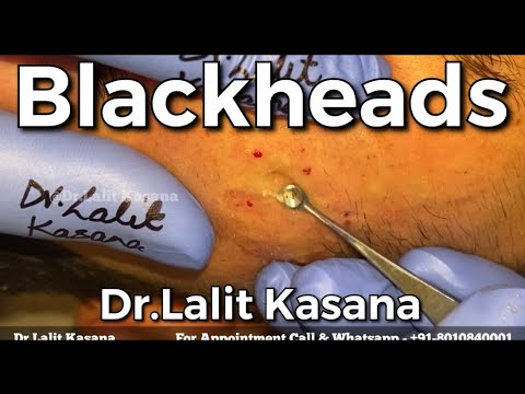 Blackhead & Whiteheads Removal by Dr.Lalit Kasana