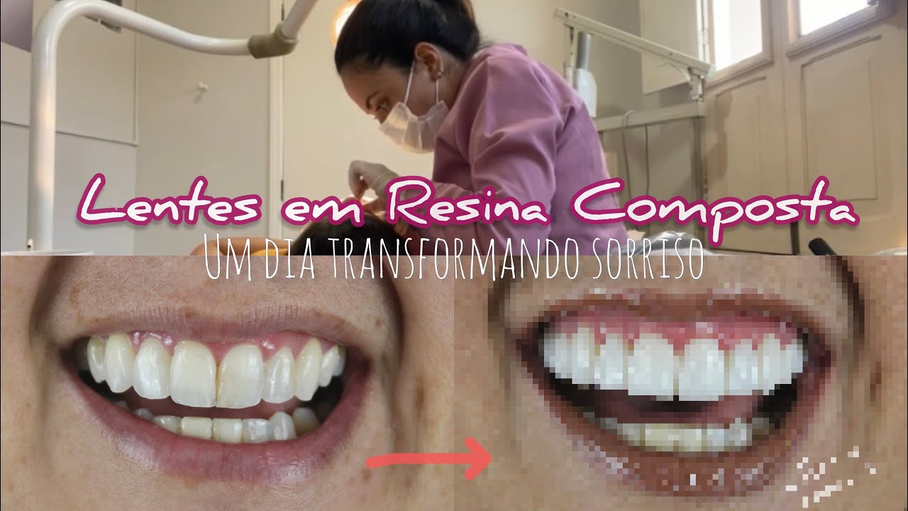 UM DIA COMIGO FAZENDO LENTES EM RESINA COMPOSTA
