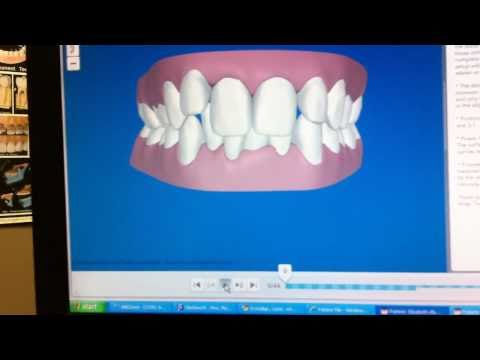 Dr. Ben Fong Invisalign Tooth Removal, Before and After animation - Liz