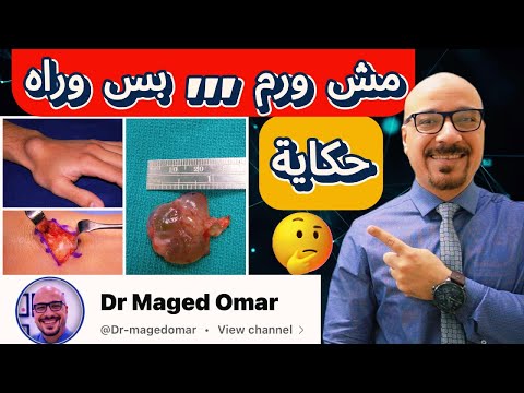   الكيس الزلالي أسبابه خطورته وعلاجه الكامل