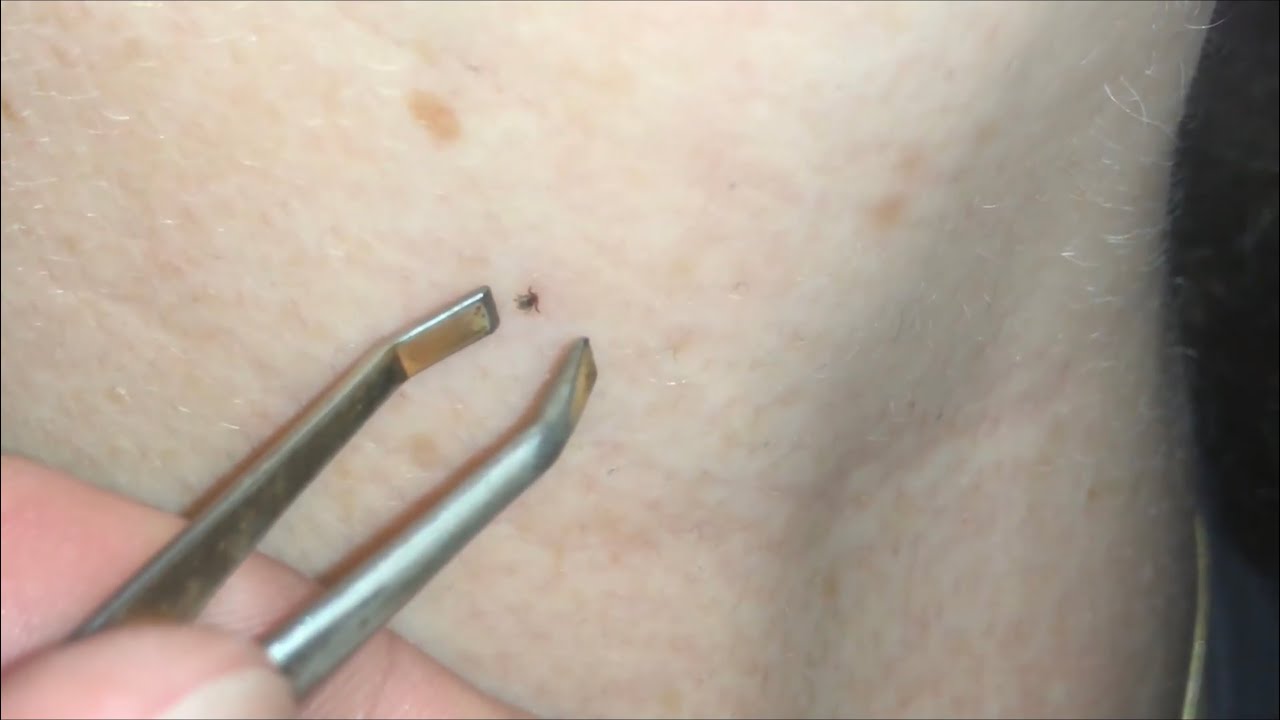 How to remove a tick with tweezer and lighter tick removal DIY YouTube
