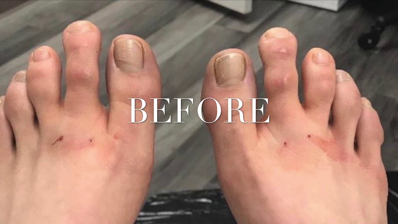 PERFORMED MINIMALLY INVASIVE TOESHORTENING / TOETUCK SURGERY (9 Weeks