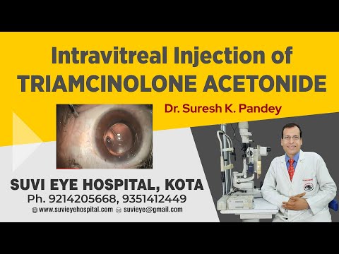 This video illustrate Intravitreal Injection of Triamcinolone Acetonide (IVTA) performed by Dr Suresh K Pandey at Suvi Eye Institute, Kota, India. The procedure of IVTA should be carried out with meticulous aseptic precaution, preferably in the operating room. It is very easily carried out under topical anesthesia. A pre-injection single drop of Povidone-Iodine (5%) solution is applied to the eye followed by thorough cleaning of the eyelashes and application of a lid speculum. 0.5% proparacaine hydrochloride drops are applied topically. Alternatively, one could also apply cotton tip pledgets soaked in lignocaine hydrochloride (4%) to the injection site for a couple of minutes prior to the injection to decrease the discomfort. Preservative free triamcinolone acetonide in a single-use bottle (40 mg/ml, 1ml bottle, Aurocort, Aurolab, Madurai, India), is drawn into a 1-cc tuberculin syringe after cleansing the top of the bottle with an alcohol wipe. A separate 27 or 26 gauge needle is placed onto the syringe, which is then inverted to remove air bubbles. The excess triamcinolone is discarded till 0.1 ml (4 mg) remains in the syringe. The injection site is usually the inferotemporal quadrant to avoid drug deposition in front of the visual axis. The stab is given 3 mm from the limbus (in aphakic and pseudophakic patients) and 3.5 mm from the limbus in phakic patients to ensure against passage of the needle through the vitreous base. The needle is usually not introduced all the <b>...</b>