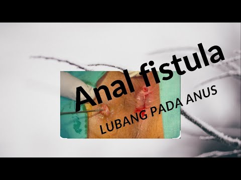 Video: Fistula - Rawatan Fistula Dengan Ubat-ubatan Rakyat Dan Kaedah