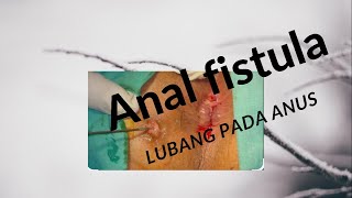 anal fistula/ lubang pada anus