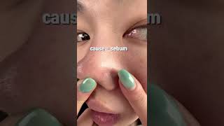 Comment “clean” if you want glass skin ✨ #skincare #porecleaning #glowup #acnecare #selfcare