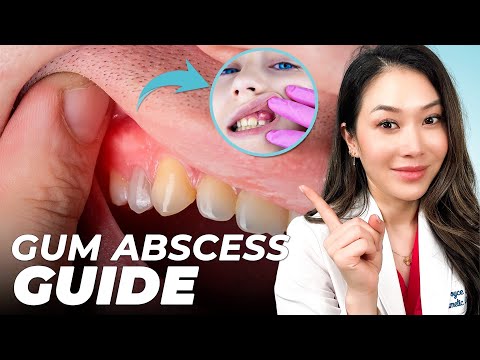 How to prevent and treat a gum abscess