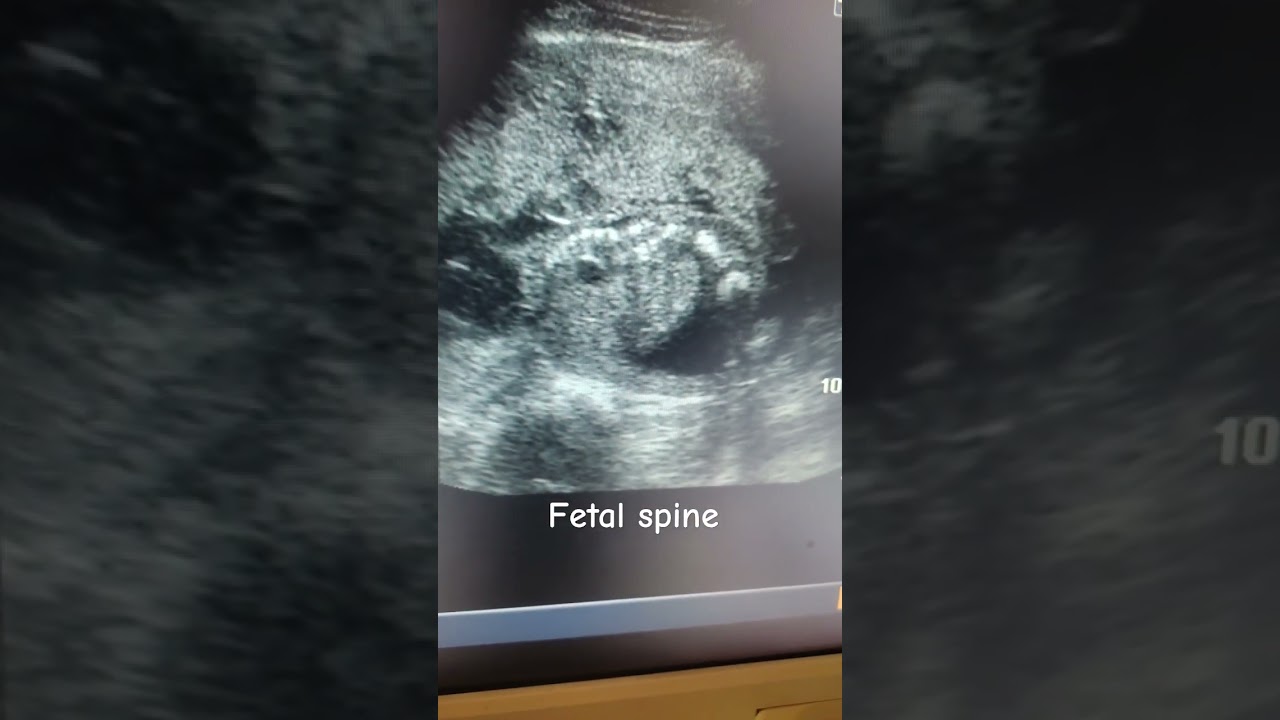 Watch spine #ultrasound #pregnancyscan #pregnancy #babyultrasound #medical #cutebaby #ytshortsindia #baby on YouTube Watch spine #ultrasound #pregnancyscan #pregnancy #babyultrasound #medical #cutebaby #ytshortsindia #baby on YouTube