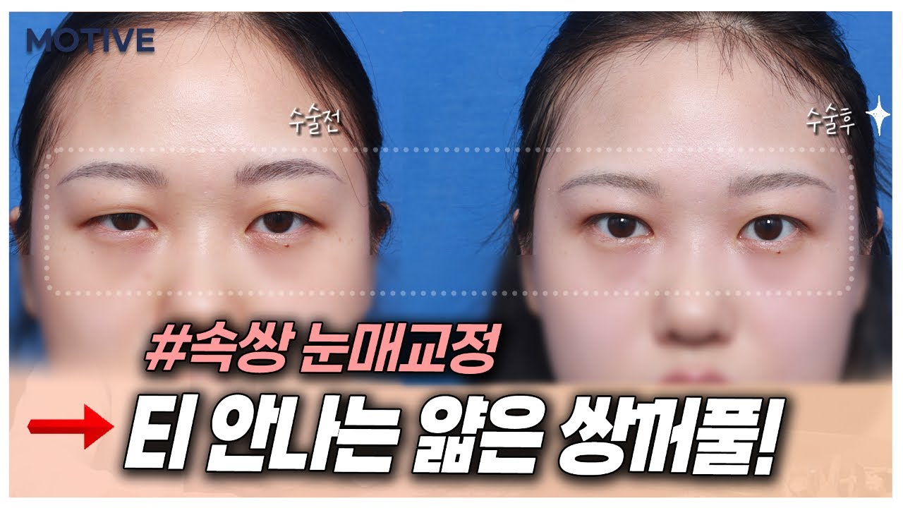 티 안나는 얇은 쌍꺼풀을 원하는 여자분들께(속쌍 눈매교정) - YouTube