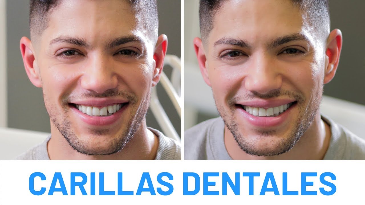 Carillas dentales antes y después