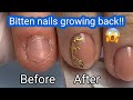 Bitten nails GROWING BACK! Amazing Transformation with Gel Overlay