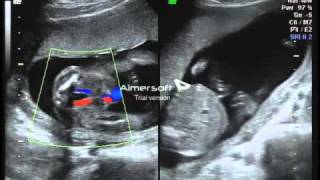 19 Week Ultrasound - Boy