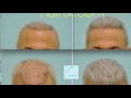 Hair Transplant Correction Video Narration in Dallas, TX