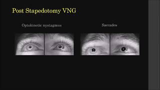 Initial experiences with VNG - Dr Sanjeev Mohanty