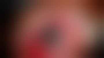 SICS Cataract Surgery - Small, Black, Shallow and Moving !!