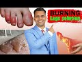 Effective Treatments & Herbs to Relieve Burning Legs & Feet ๐ฅ