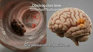 Ictus isquémico en 3D qué pasa dentro del cerebro, síntomas, tratamiento y prevención