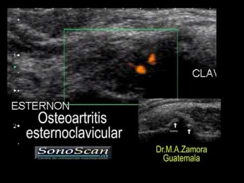camera iphone 8 plus apk Osteoarthritis (OA) of the sternoclavicular (SC) joint. Osteoartritis esternoclavicular.