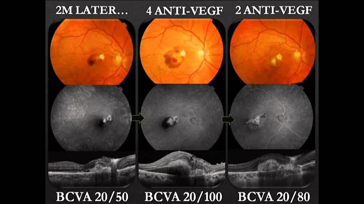 Choroidal neovascularizati...  after intraocular foreign body - Video abstract [62312]