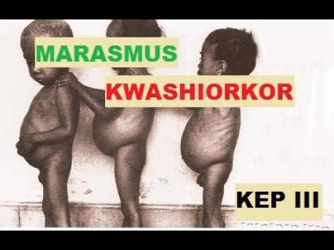 Kurang Gizi Pada Anak | Marasmus Kwashiorkor | KEP |  Penyakit Metabolik | Penjelasan Singkat