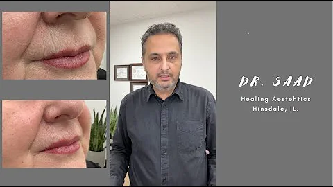 Women get more smokers lines than men. How we treat smokers lines.