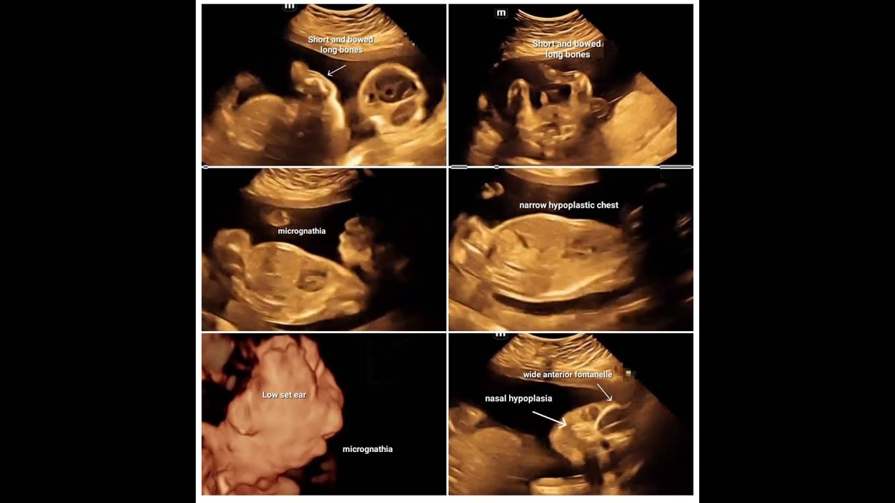 asphyxiating skeletal dysplasia fetal ultrasound  for DD ? campomelic dysplasia