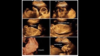 Asphyxiating Skeletal Dysplasia Fetal Ultrasound For Dd ? Campomelic Dysplasia