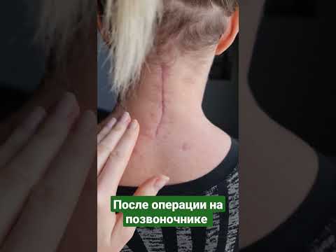 ПЕРЕЛОМ ПОЗВОНОЧНИКА. ШЕЙНЫЙ