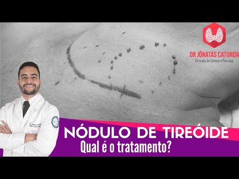 Vídeo: Quem trata os nódulos da tireoide?