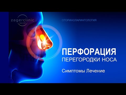 Перфорация перегородки носа | Симптомы, особенности лечения