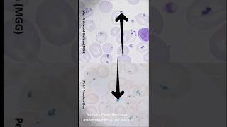 Mastering Pappenheimer Bodies Identification: Pathology Slide Guide for Neet PG &amp; Next PG Students