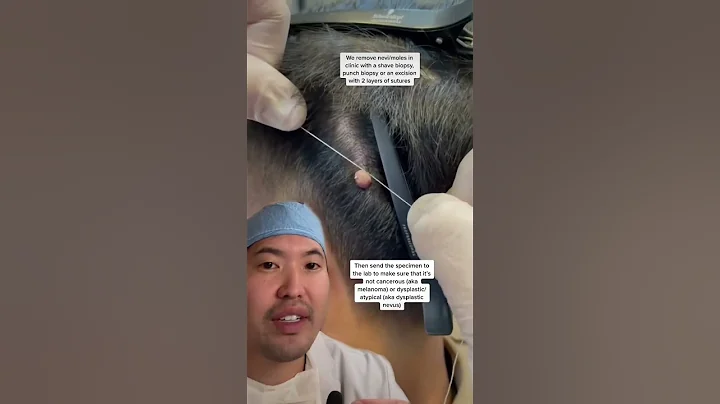 Removing moles at the barber with string? #shorts