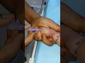 IV Cannula #hospitality #drsonu_vlogs #newbornbaby #ivcannula #pediatric #babycare #kidsvideo #viral