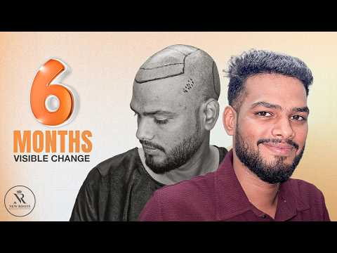 Real Hair. Real Growth. Real Confidence. 😍 | Hair Transplant in Raipur | New Roots