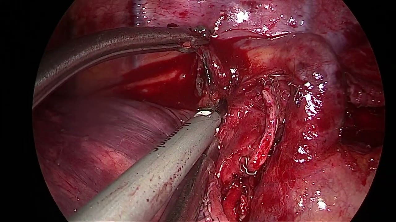 Uniportal VATS right upper lobectomy and MLND