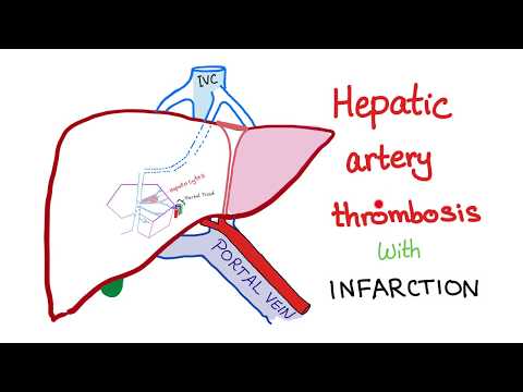 Hepatic Artery Thrombosis with infarction