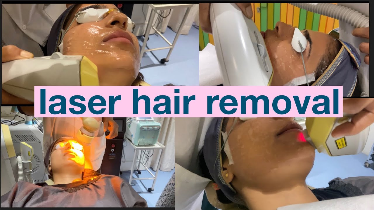 'LASER' Hair Removal Treatment | My Experience | SEEMA RAO