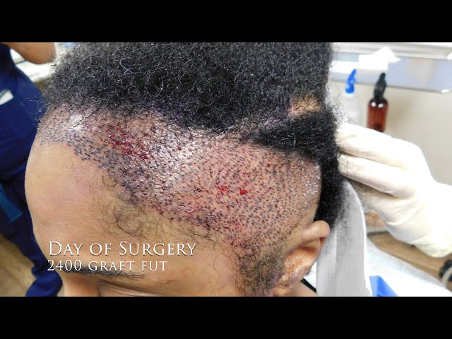 Hair Transplant for Black Women - Female Hair Transplant Results for Hair Loss