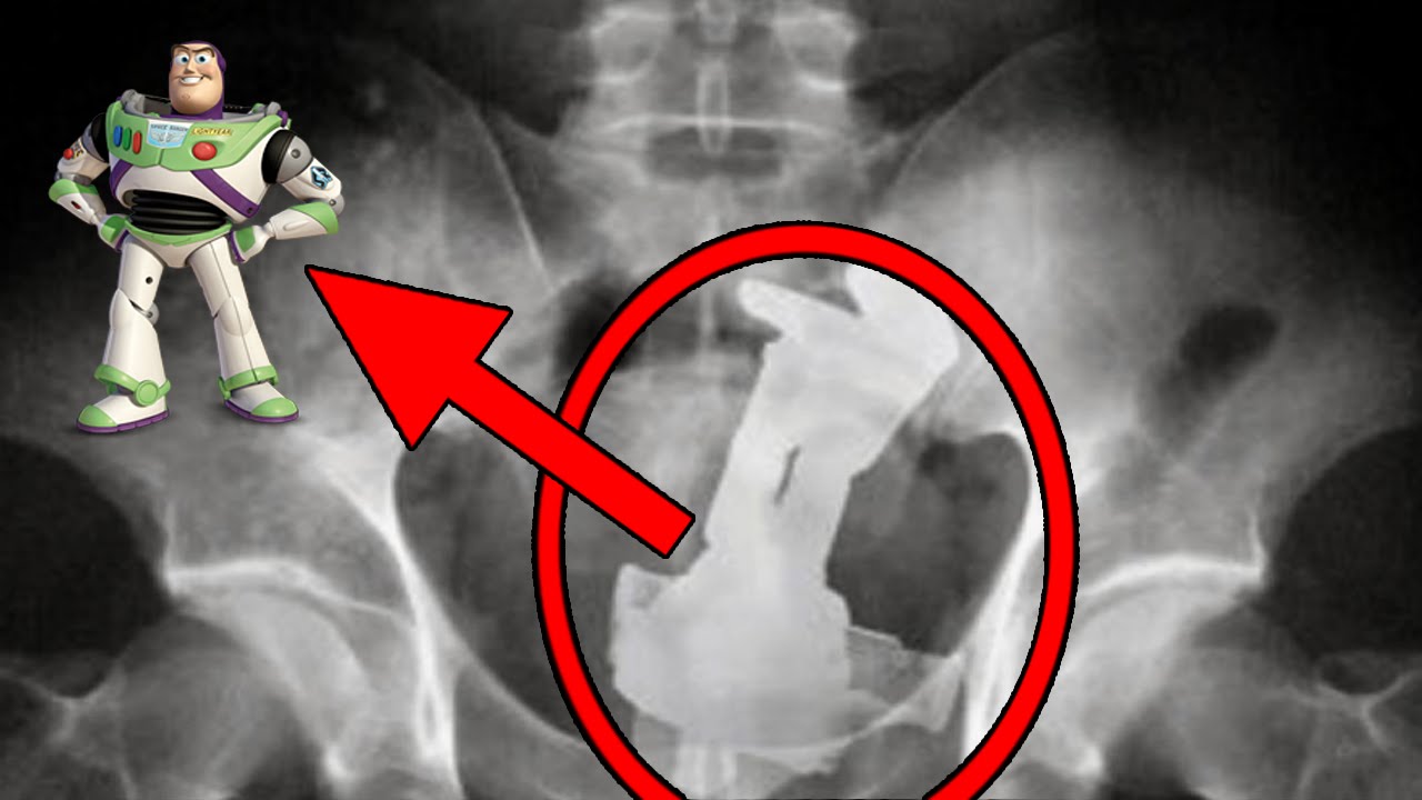 5 MOST BIZARRE Items Found Inside People!