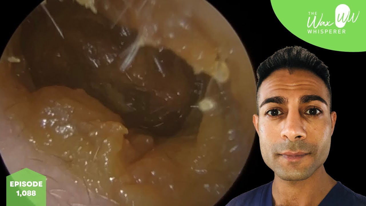 1,088 10 Years Worth of Ear Wax Removal YouTube