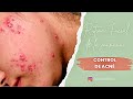 Limpieza facial control de acné l Rutina matutina l Skincare Routine l acne Hormonal