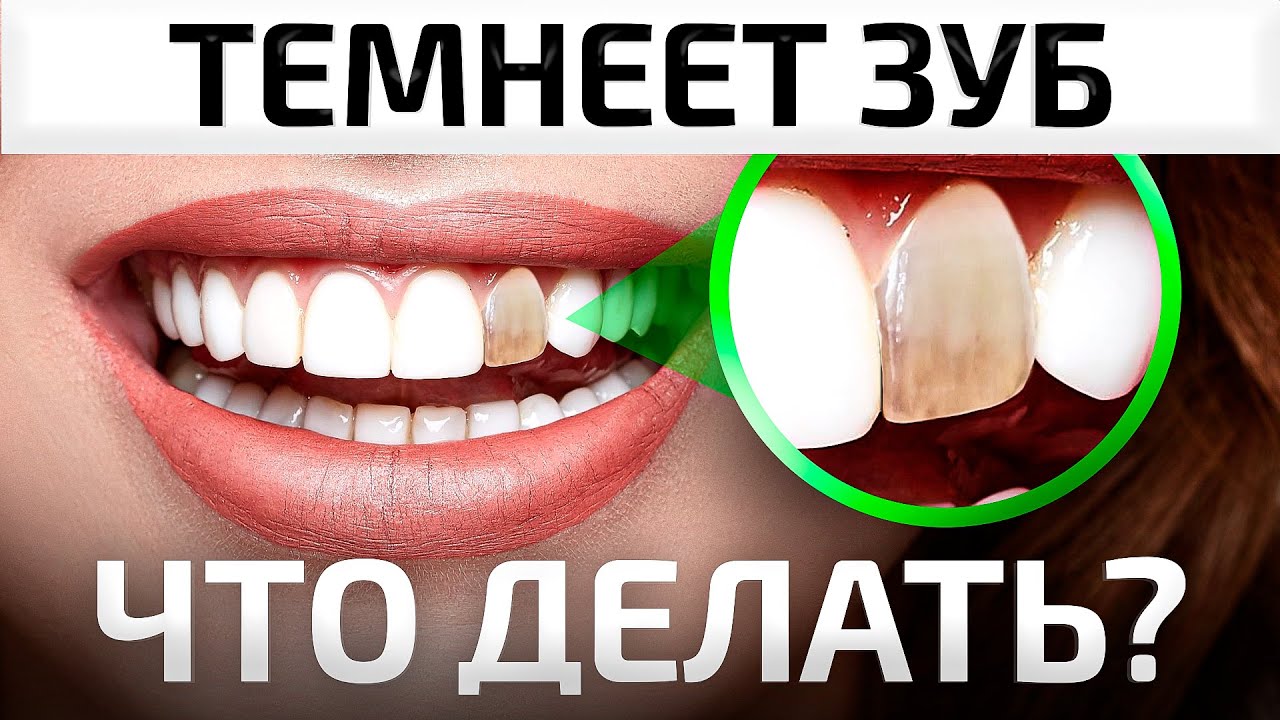 Что, если ЗУБ потемнел! ПОСЛЕДСТВИЯ удаления зубного нерва