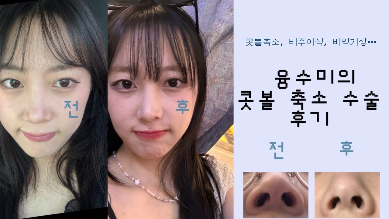 vlog) 콧볼축소수술 후기 브이로그✨