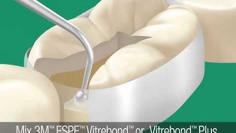 Posterior Restorations—Single-Shade Technique