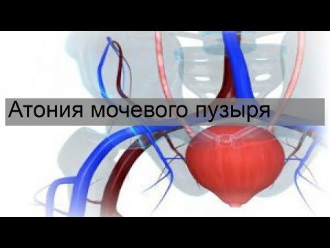 Видео: Есть ли атония мочевого пузыря?